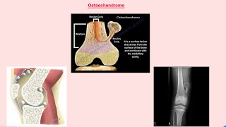 Orthopédie  ostéochondrome [upl. by Robbin]