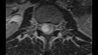 Intradural Schwannoma [upl. by Ggerg]