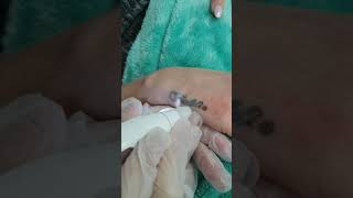 Tattoo removal using plasma pen [upl. by Anirehtak]