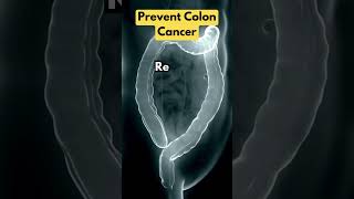 How Do You Prevent Colon Cancer [upl. by Cardinal]