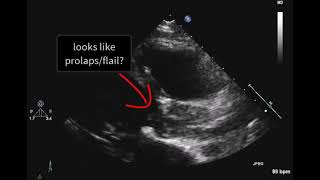 Destructed aortic valve [upl. by Niai]