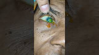 Bacterial corneal ulcer c leaucoma opacity in cornea surface loss off vision in Both eye [upl. by Laurinda]