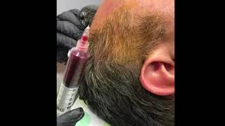 Scalp PRP and Amnion Injection [upl. by Galer]