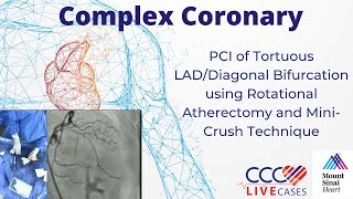 PCI of Tortuous LADDiagonal Bifurcation using Rotational Atherectomy amp MiniCrush Technique Nov 2023 [upl. by Harret]