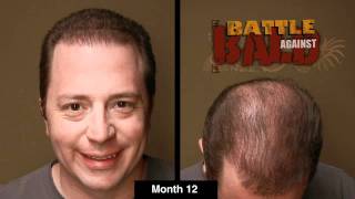 Bosley Hair Transplant Results After 12 Months Time Lapse [upl. by Anreval]