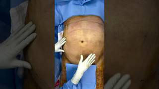 Lipoescultura con Lipotransferencia en paciente MASCULINO de 93 kg 💪🔥 cirugiaplastica lipo [upl. by Asehr]