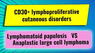 CD30 lymphoproliferative disorders lymphomatoid papulosis anaplastic large cell lymphoma [upl. by Ardisi325]