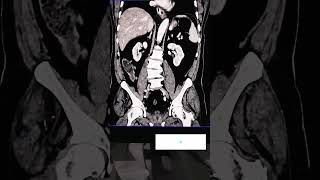 CT Scan Abdomen With Contrast [upl. by Hanni]