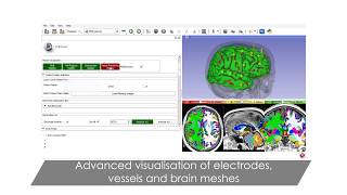 Epilepsy Surgical Treatment Automated Planning StereoElectroEncephaloGraphy SEEG [upl. by Lamahj]