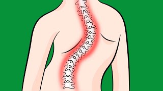 How to Fix Idiopathic Scoliosis Naturally [upl. by Nnylyrehc]