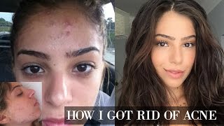 Remove ACNE FAST With These Treatment Secrets [upl. by Gaskin]