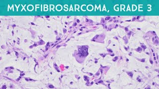 Myxofibrosarcoma grade 3 high grade pathology sarcoma dermpath dermatology dermatopathology [upl. by Rodi]