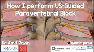 How I Perform USGuided Paravertebral Blocks [upl. by Iegres346]