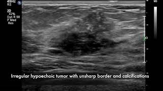 Breast ultrasound  cancer [upl. by Aldos]