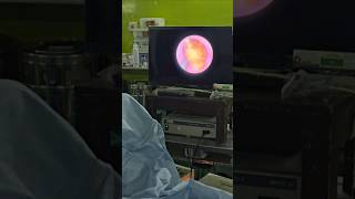 How ureteric stone look in endoscopy ureteralstone stone urs [upl. by Trueman]