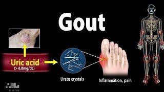 Gout Pathophysiology Causes Symptoms Risk Factors Diagnosis And Treatment Animation [upl. by Liagibba510]