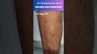 Laser  Foam Sclerotherapy treatment for varicose veins Varicose veins treatment in Ranchi [upl. by Redmond]