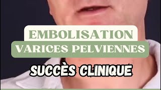 EMBOLISATION VARICES PELVIENNES ➡️ succès clinique [upl. by Arodaeht850]