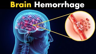 What Happens in Brain hemorrhage  Symptoms Causes and Treatment 3d animation [upl. by Jakoba]