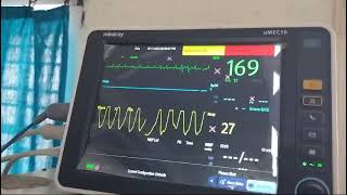 Tachypnoea in severe mitral stenosis with atrial fibrillation and fast ventricular rate [upl. by Ais]