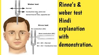 Rinne amp Weber test demonstration in Hindi explanation msn gnmcourse nursing ear [upl. by Yentihw]