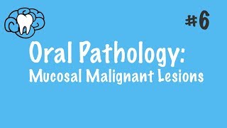 Oral Pathology  Mucosal Malignant Lesions  INBDE ADAT [upl. by Athey]