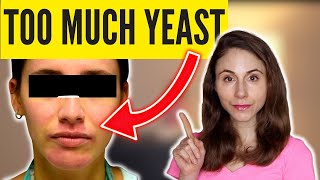 6 SIGNS OF TOO MUCH YEAST SKIN DrDrayzday [upl. by Esinaj200]