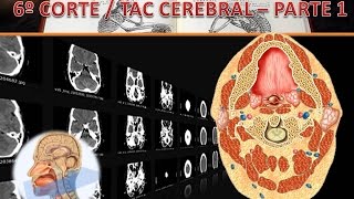 TAC Cerebral corte 6 parte 1 [upl. by Toth758]