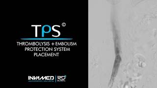 Mantis®️ Thrombectomy System for DVT [upl. by Soutor]