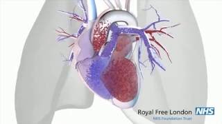 What is pulmonary hypertension [upl. by Rosenwald]