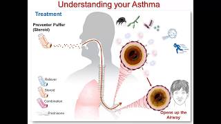 Understanding Your Asthma Part 3 Steroid Medication [upl. by Barolet]