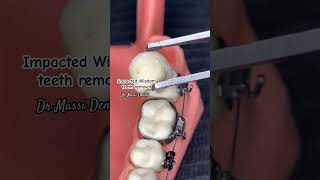 Impacted Wisdom Tooth Removal wisdom teethoralhealth viralshorts youtubeshorts trendingfypl [upl. by Evette]