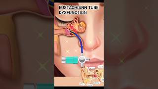 Eustachian Tube Dysfunction ear dysfunction treatment [upl. by Ecnahc]