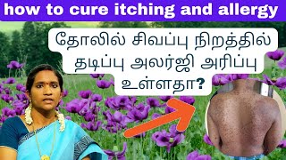 Skin Allergy Medicine in Tamil How to Treat Allergies and Urticaria  தோல் அலர்ஜி குணமாக [upl. by Aivatnahs]