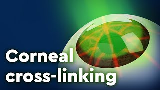 Corneal Collagen Crosslinking and Keratoconus Treatment [upl. by Ayimat891]