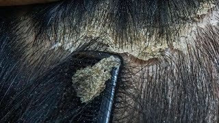 ASMR Comfortable Scalp Care Dandruff Removal for Sleep and Stress Relief 7 [upl. by Aicinod]