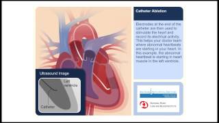 Catheter Ablation Animation Video [upl. by Flavia]