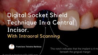 Digital Socket Shield Technique [upl. by Nelehyram472]