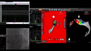 Great cardiac vein GCV VTAblation in coronarySinus EPStudy [upl. by Ilamad]