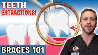 BRACES 101 Tooth Extractions For Braces  Treatment Minute Talk [upl. by Odella]