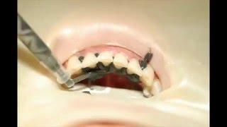 How to fabricate a periodontal splint or fixed orthodontic retainer [upl. by Seaddon108]