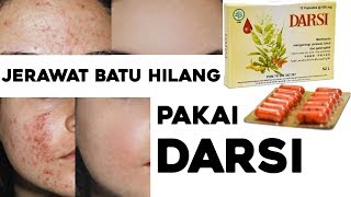 Cara Sembuh dari Jerawat BATU I PENGALAMAN PRIBADI minum DARSI [upl. by Eleanor]