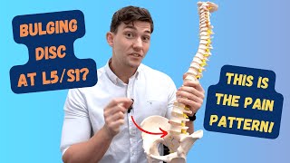 L5S1 Bulging Disc Pain Pattern Explained [upl. by Bard]