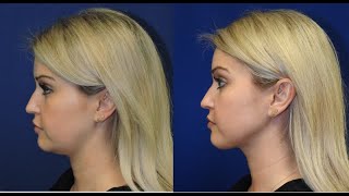 ChinNeck Liposuction Before  After  Nashville Plastic Surgeon [upl. by Strain19]