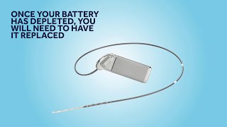 Sacral Neuromodulation SNM battery needs replacing what to expect [upl. by Krucik59]