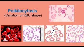 Poikilocytosis Variation of RBC shape [upl. by Charters]