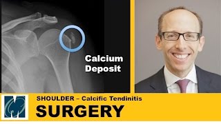 Calcific tendinitis of the shoulder [upl. by Ceevah]