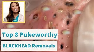 Dr Pimple Poppers 8 WORST Blackhead Removals  Youre not going to want to eat while you watch this [upl. by Cattan19]