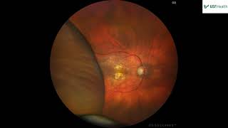 Peripheral Exudative Chorioretinopathy PECR transient choroidal mass Alex Weppelmann  2023 03 10 [upl. by Jeffry]