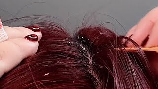 ASMR Scalp Care Exfoliating Hand amp Comb Dandruff Removal No Talking [upl. by Margi439]